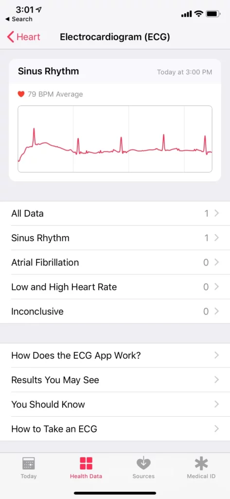 Apple Watch ECG; Arrhythmia Detection Smartwatch Comparison - Apple vs Fitbit vs Withings