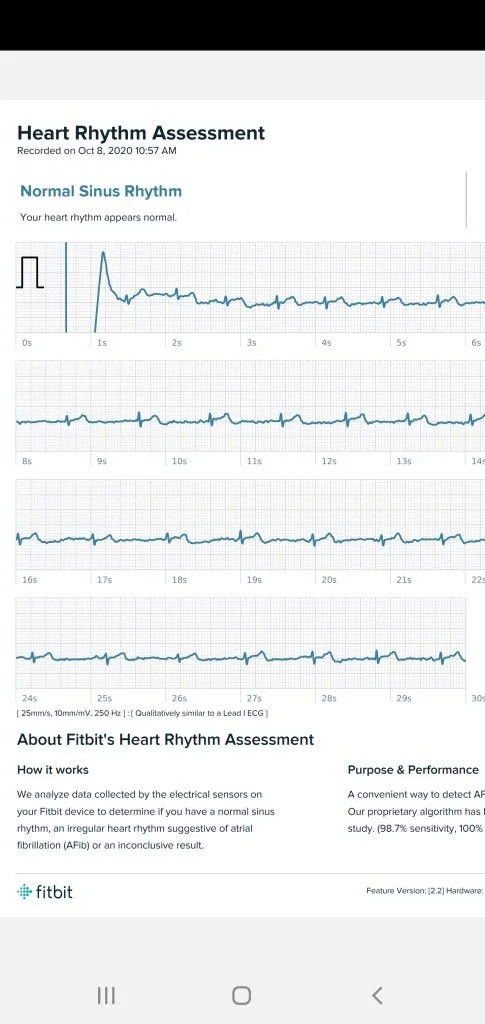Fitbit Sense 2 ECG; Arrhythmia Detection Smartwatch Comparison - Apple vs Fitbit vs Withings